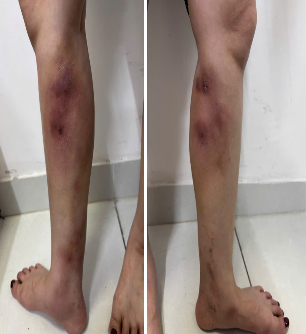 Cận cảnh đ&ocirc;i ch&acirc;n của c&ocirc; g&aacute;i 29 tuổi sau ti&ecirc;m filler thẳng ch&acirc;n tại nh&agrave;- Ảnh 2.