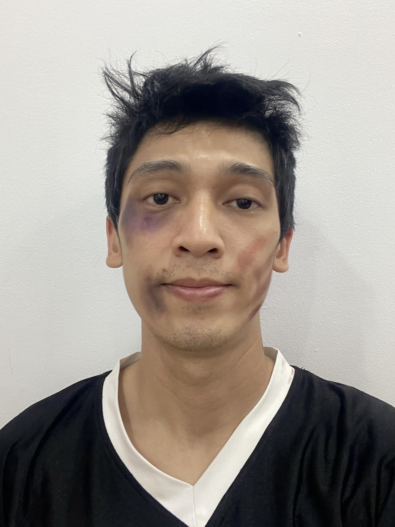 Nam ca sĩ Việt mặt mũi bầm dập v&igrave; xin vợ chơi pickleball, chuyện g&igrave; đ&acirc;y?- Ảnh 1.