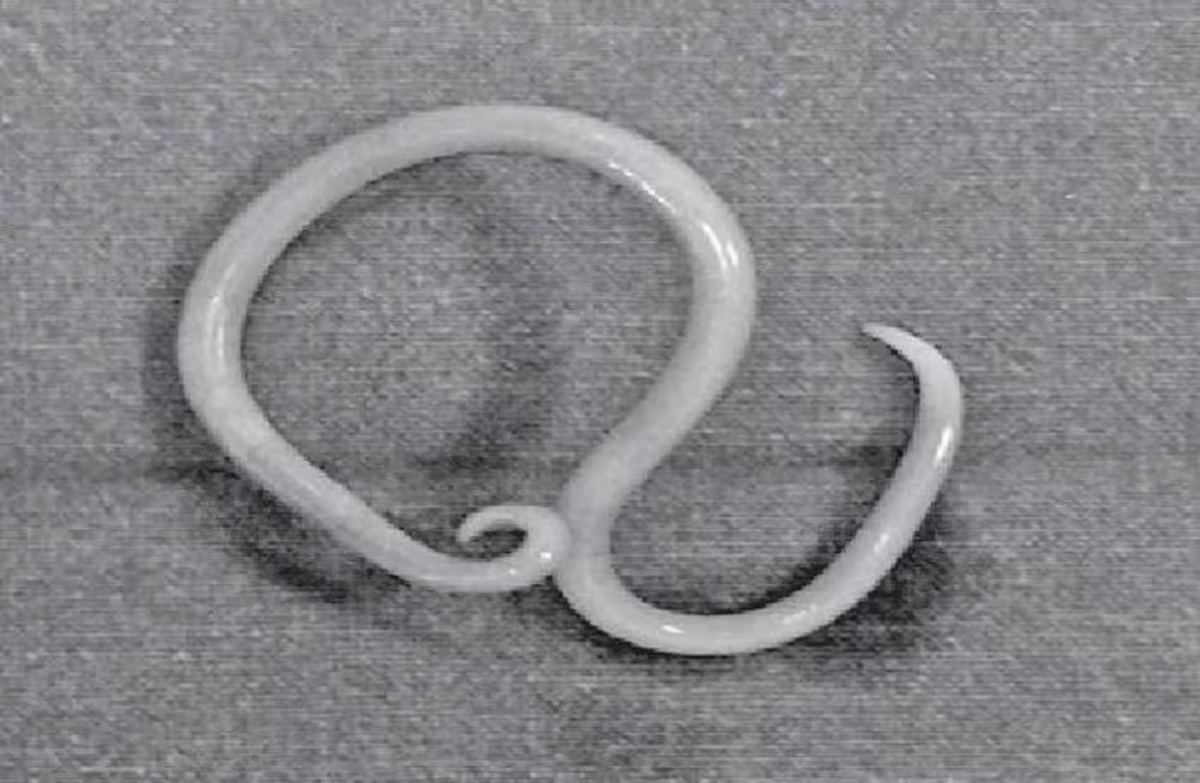 Thiếu ni&ecirc;n 15 tuổi bị đau bụng th&uacute;c ngược l&ecirc;n, b&aacute;c sĩ ph&aacute;t hiện "b&iacute; mật" đ&aacute;ng sợ b&ecirc;n trong- Ảnh 1.