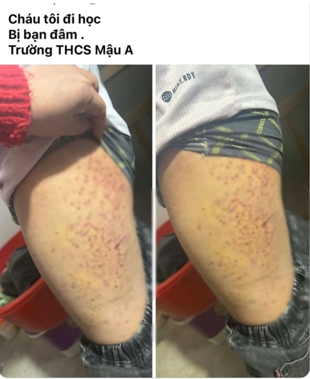 Nữ sinh lớp 7 d&ugrave;ng b&uacute;t bi đ&acirc;m hơn 20 lần lần v&agrave;o đ&ugrave;i bạn học: Đ&acirc;y l&agrave; nguy&ecirc;n nh&acirc;n- Ảnh 1.