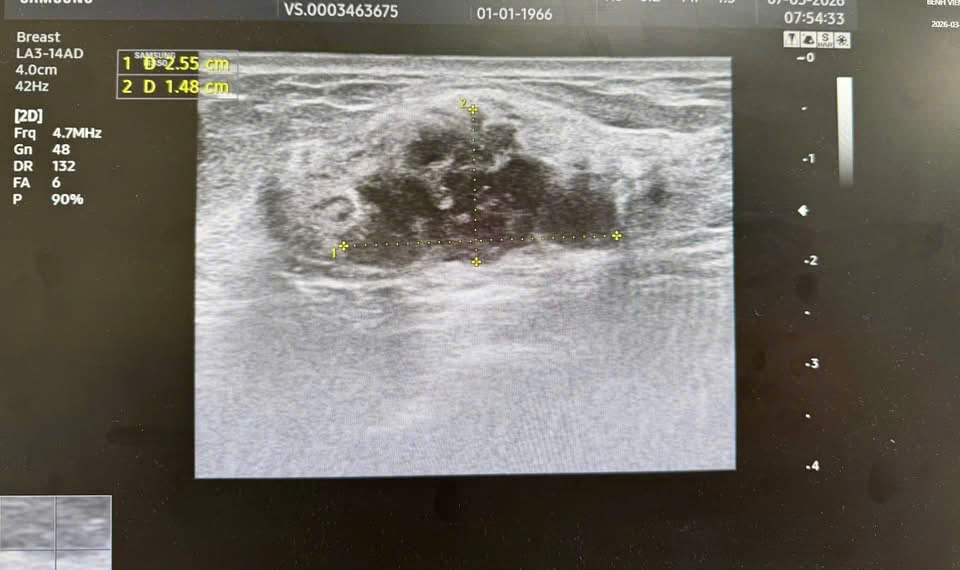 Ph&aacute;t hiện ung thư khi vẫn &ldquo;khỏe mạnh&rdquo;: B&aacute;c sĩ ung bướu cảnh b&aacute;o sai lầm nhiều người mắc phải- Ảnh 1.