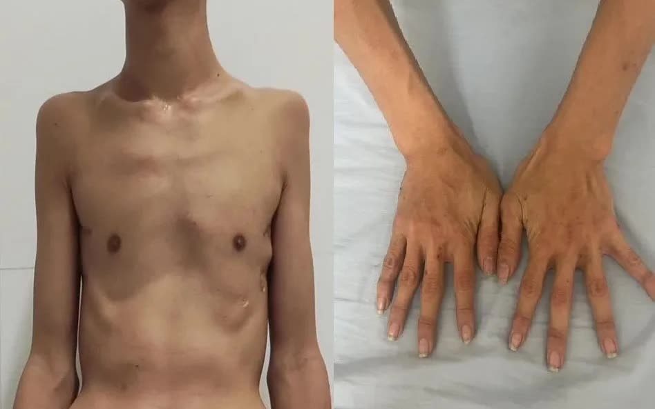 Ph&aacute;t hiện ca bệnh Marfan hiếm gặp ở nam thanh ni&ecirc;n 18 tuổi- Ảnh 1.