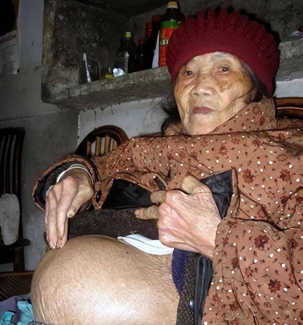 Cụ b&agrave; 91 tuổi ng&atilde; khi đi lấy nước, v&agrave;o viện th&igrave; ph&aacute;t hiện &ldquo;mang thai&rdquo;: B&iacute; mật về "b&agrave;o thai ho&aacute; đ&aacute;"- Ảnh 3.