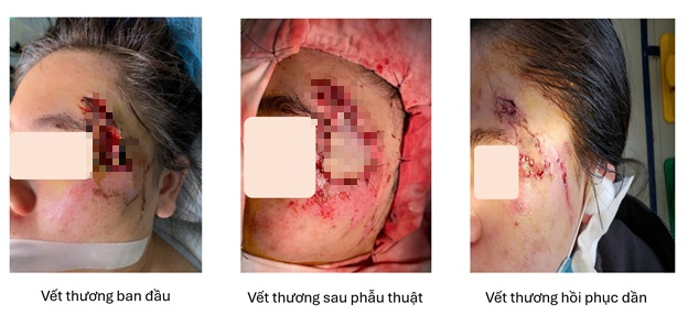 Gh&eacute;p da th&agrave;nh c&ocirc;ng cho c&ocirc; g&aacute;i bị hoại tử v&ugrave;ng mặt sau tai nạn giao th&ocirc;ng- Ảnh 1.