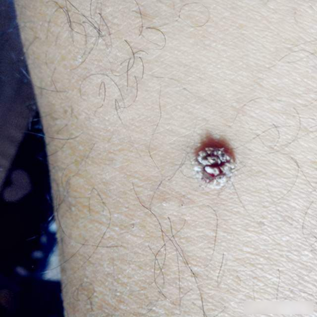 Nữ streamer 25 tuổi mắc ung thư cổ tử cung: 