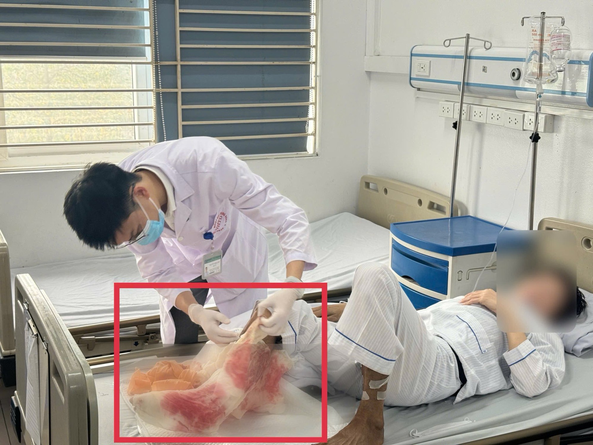 Su&yacute;t mất ch&acirc;n v&igrave; đắp l&aacute; chữa bỏng lửa suốt 1 th&aacute;ng- Ảnh 1.