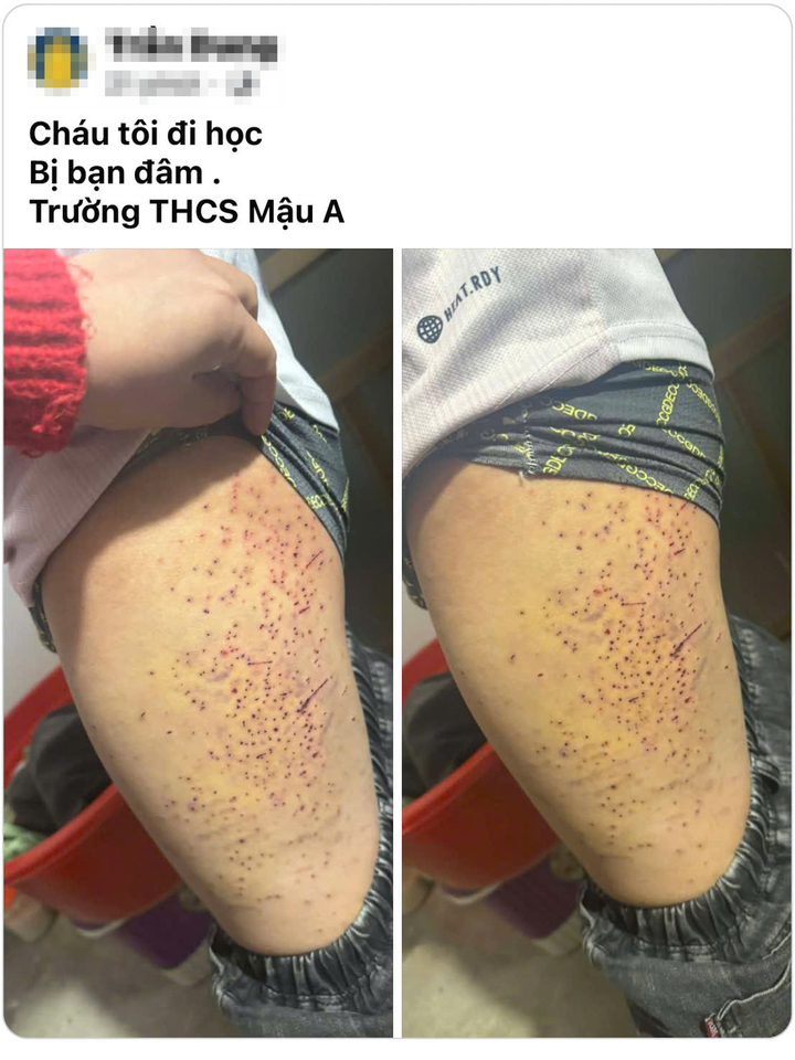 X&aacute;c minh th&ocirc;ng tin học sinh nghi bị bạn d&ugrave;ng vật nhọn g&acirc;y thương t&iacute;ch- Ảnh 1.