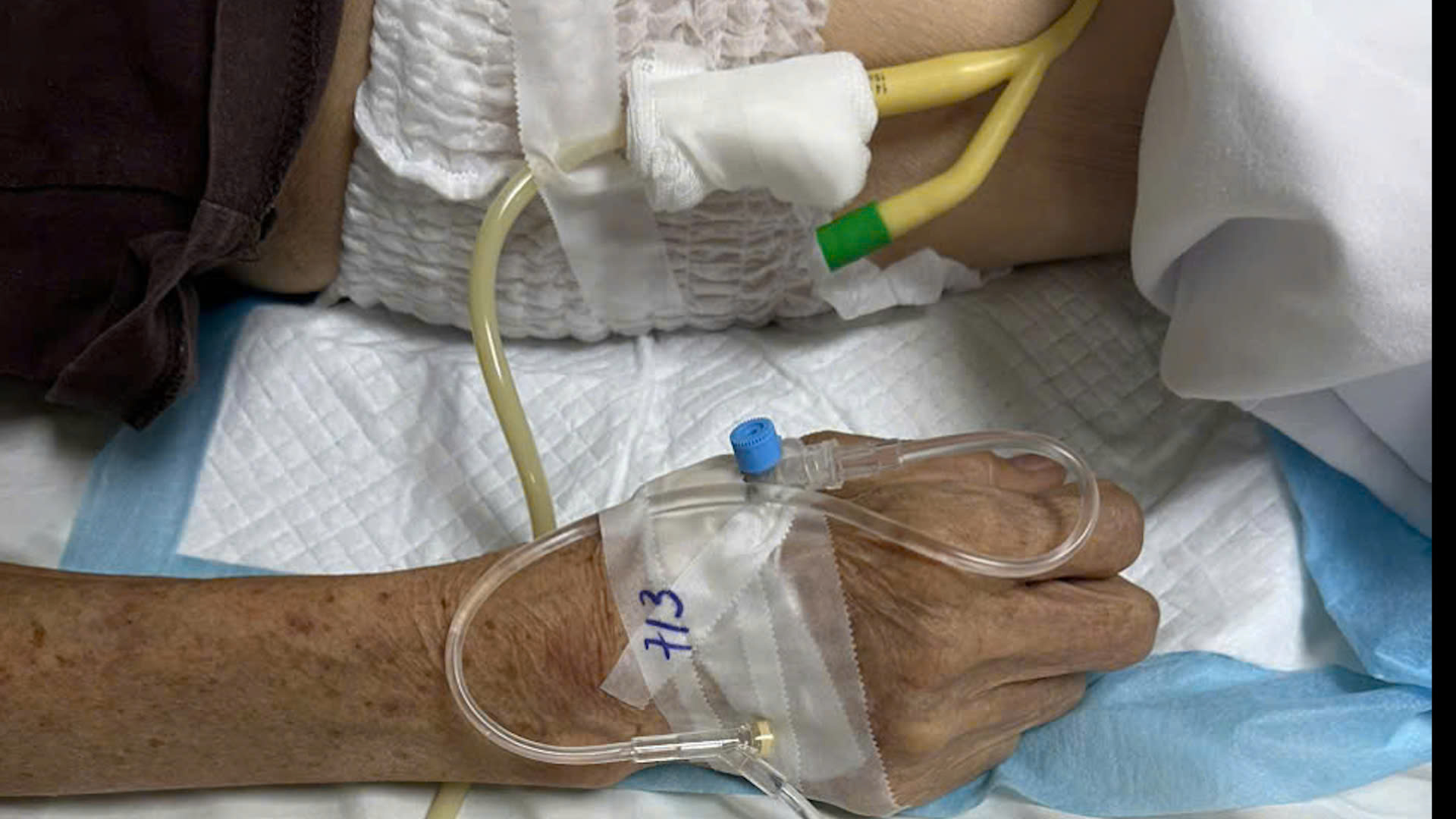 Cụ &ocirc;ng nhiều ng&agrave;y b&iacute; tiểu, nước tiểu trắng đục như sữa- Ảnh 1.