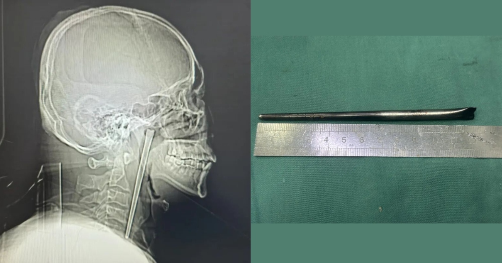 Người đ&agrave;n &ocirc;ng đau họng dữ dội, b&aacute;c sĩ lấy ra thứ đ&aacute;ng sợ b&ecirc;n trong- Ảnh 1.