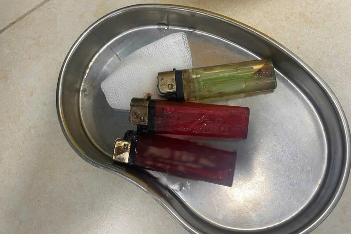 B&aacute;c sĩ sốc khi ph&aacute;t hiện 3 chiếc bật lửa trong bụng nam thanh ni&ecirc;n- Ảnh 1.