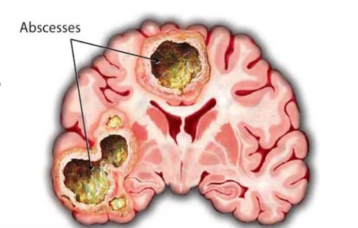 Ph&aacute;t hiện &aacute;p xe n&atilde;o nguy hiểm sau 2 tuần đau đầu, buồn ngủ triền mi&ecirc;n- Ảnh 1.