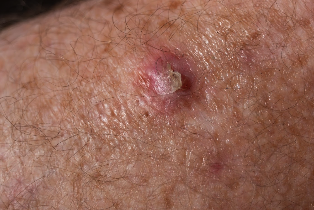 Ung thư da tr&ocirc;ng như thế n&agrave;o? Đ&acirc;y l&agrave; 3 h&igrave;nh ảnh để nhận biết- Ảnh 5.