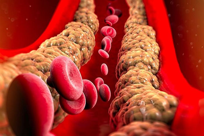 Cholesterol ''tốt'' v&agrave; ''xấu'' kh&aacute;c nhau thế n&agrave;o? L&agrave;m sao để giảm mỡ m&aacute;u ''xấu'', tăng mỡ m&aacute;u ''tốt''?