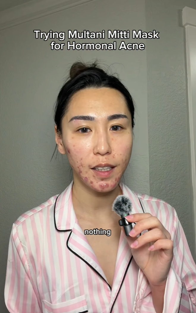 Bị đuổi việc, c&ocirc; g&aacute;i 27 tuổi để mặt mộc với mảng mụn lớn l&ecirc;n mạng t&acirc;m sự v&agrave; c&aacute;i kết bất ngờ- Ảnh 3.