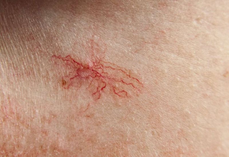 Muốn biết gan khỏe hay yếu, chỉ cần nh&igrave;n v&agrave;o l&agrave;n da sẽ r&otilde;: C&oacute; 5 dấu hiệu n&agrave;y phải đi kh&aacute;m ngay- Ảnh 3.