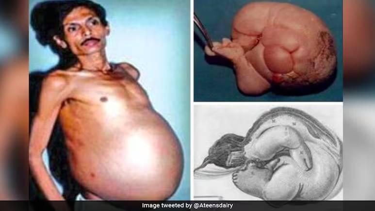 Người đ&agrave;n &ocirc;ng 60 tuổi "mang thai" suốt 36 năm, nh&oacute;m b&aacute;c sĩ kinh ho&agrave;ng khi tiến h&agrave;nh phẫu thuật- Ảnh 1.