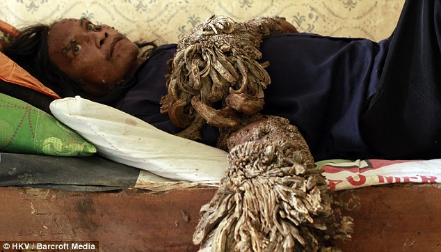 42 năm cuộc đời đầy bi kịch của "người c&acirc;y"- Ảnh 3.