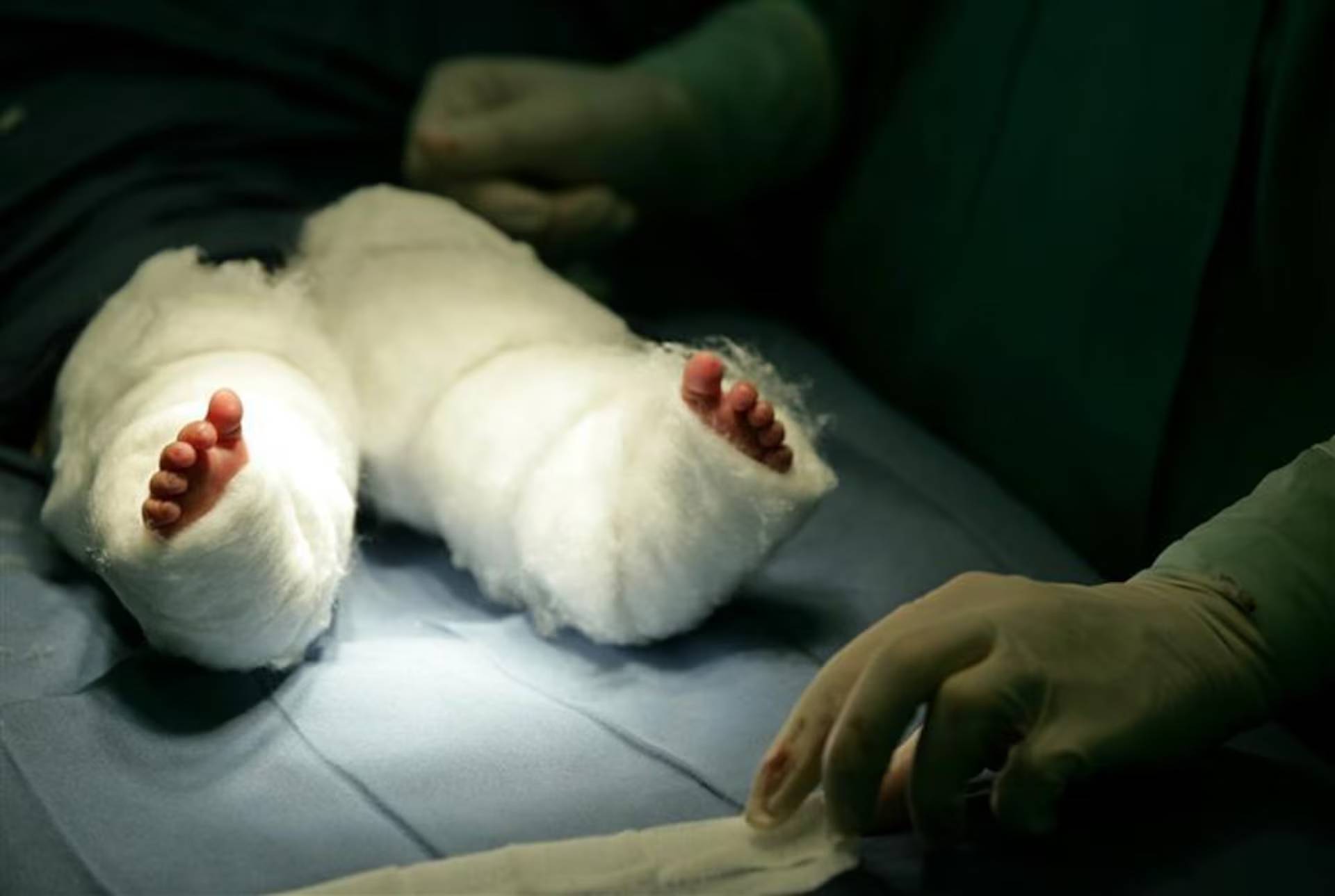 N&agrave;ng ti&ecirc;n c&aacute; ngo&agrave;i đời thực: B&eacute; g&aacute;i ch&agrave;o đời với đ&ocirc;i ch&acirc;n d&iacute;nh liền v&agrave; 15 năm sống phi thường như "một kỳ t&iacute;ch y học"- Ảnh 4.