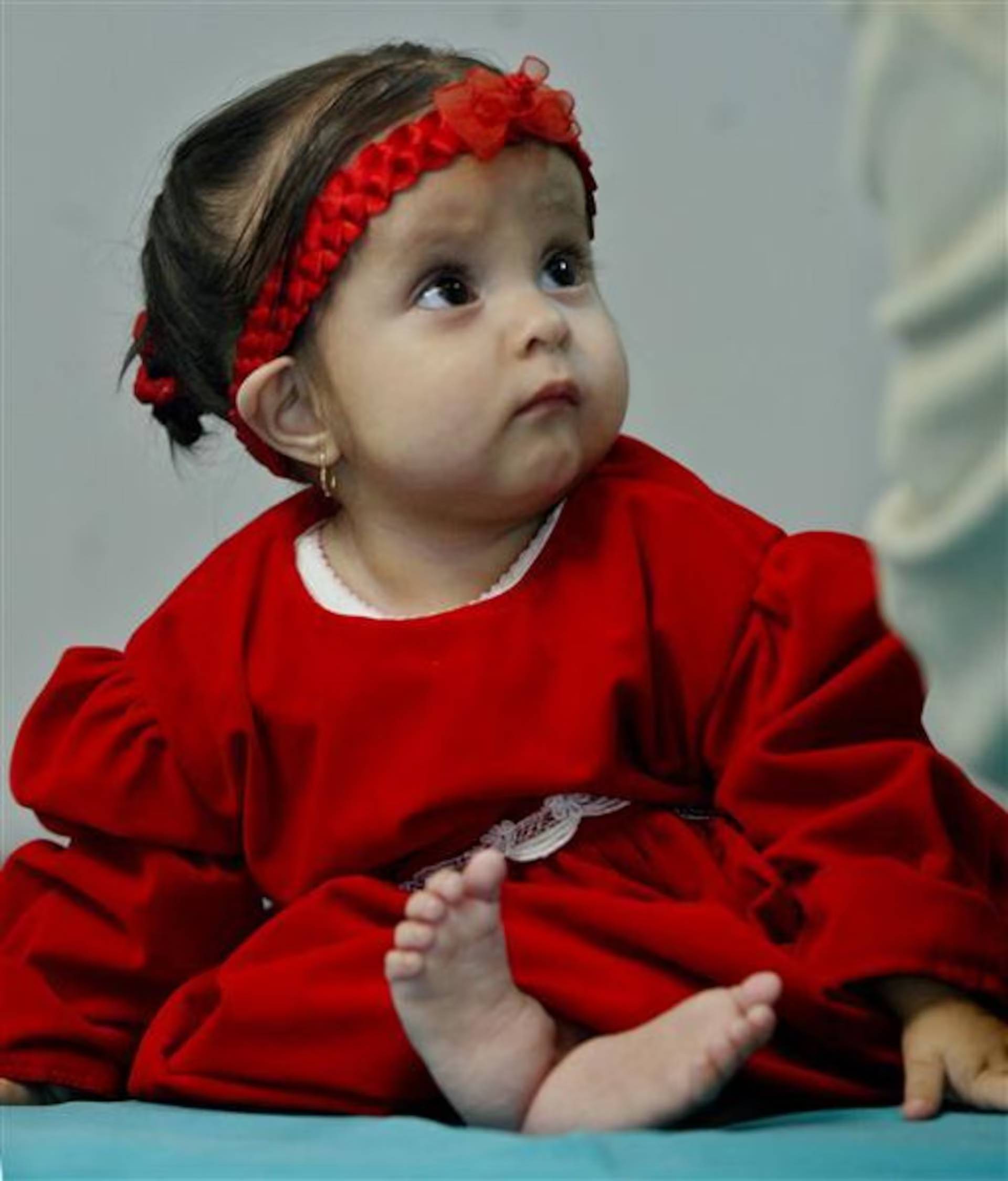 N&agrave;ng ti&ecirc;n c&aacute; ngo&agrave;i đời thực: B&eacute; g&aacute;i ch&agrave;o đời với đ&ocirc;i ch&acirc;n d&iacute;nh liền v&agrave; 15 năm sống phi thường như "một kỳ t&iacute;ch y học"- Ảnh 2.