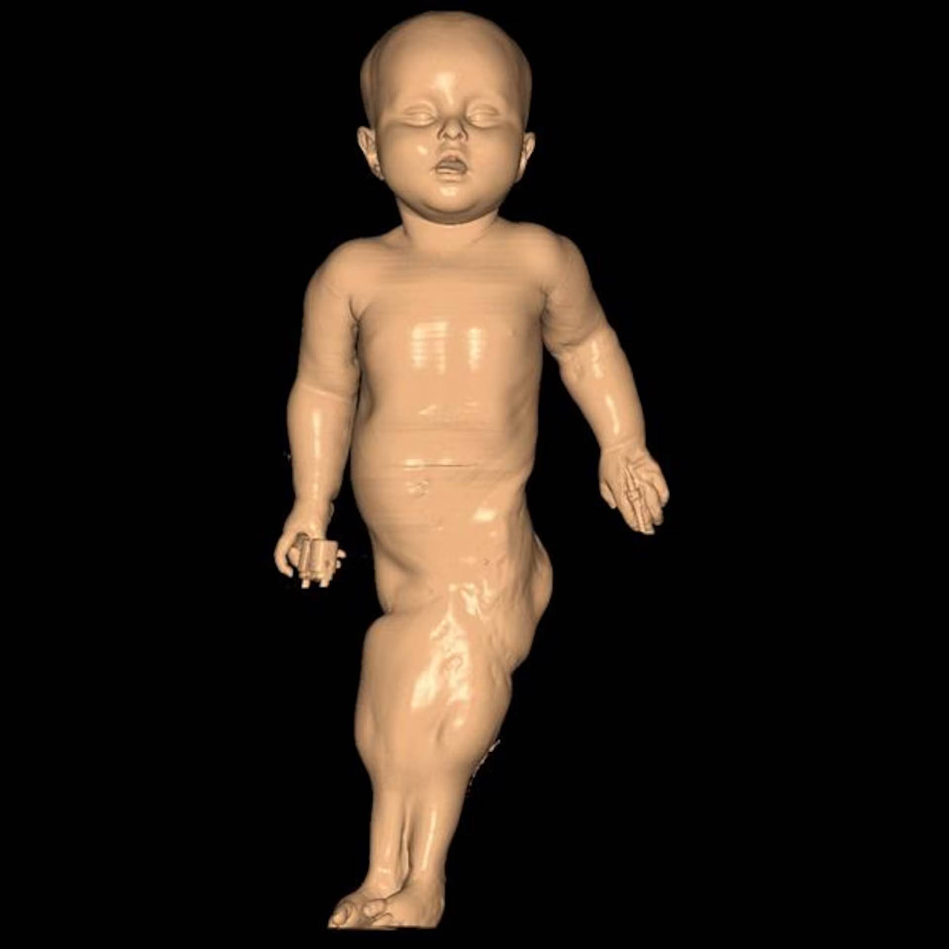 N&agrave;ng ti&ecirc;n c&aacute; ngo&agrave;i đời thực: B&eacute; g&aacute;i ch&agrave;o đời với đ&ocirc;i ch&acirc;n d&iacute;nh liền v&agrave; 15 năm sống phi thường như "một kỳ t&iacute;ch y học"- Ảnh 3.