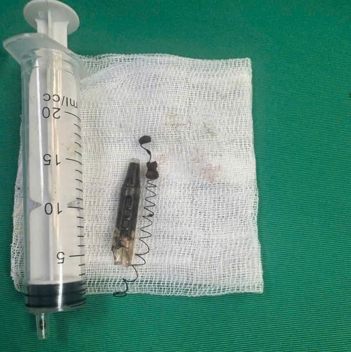 Ch&agrave;ng trai đau th&aacute;i dương suốt 13 năm, b&aacute;c sĩ ph&aacute;t hiện ra b&iacute; mật "đ&aacute;ng sợ" b&ecirc;n trong- Ảnh 2.