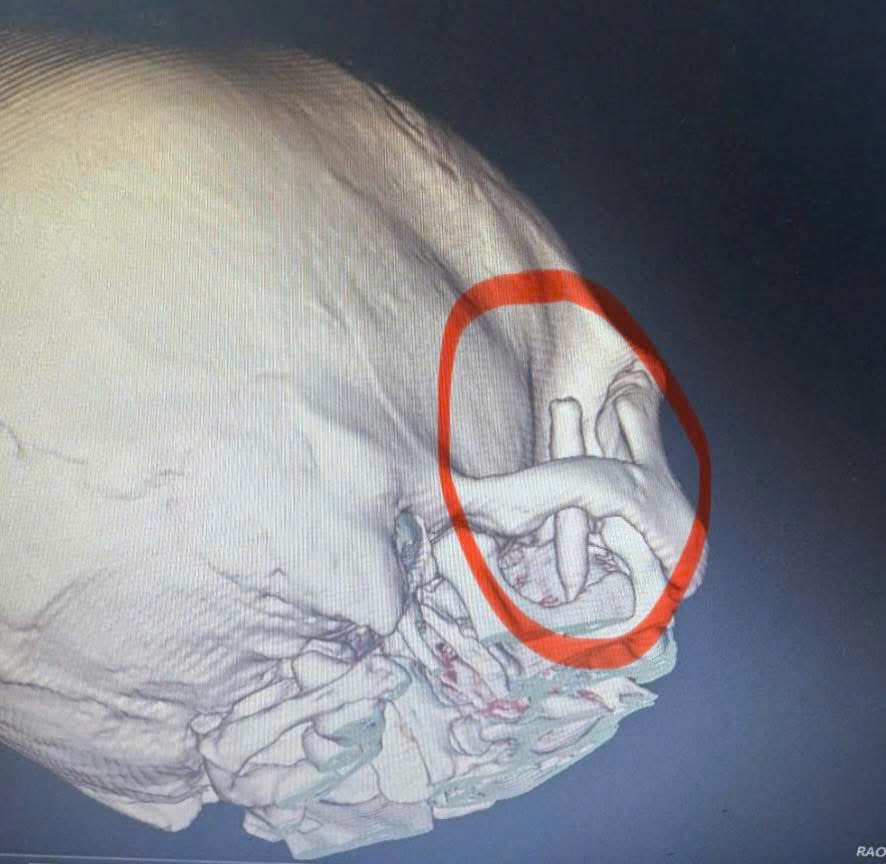 Ch&agrave;ng trai đau th&aacute;i dương suốt 13 năm, b&aacute;c sĩ ph&aacute;t hiện ra b&iacute; mật "đ&aacute;ng sợ" b&ecirc;n trong- Ảnh 1.