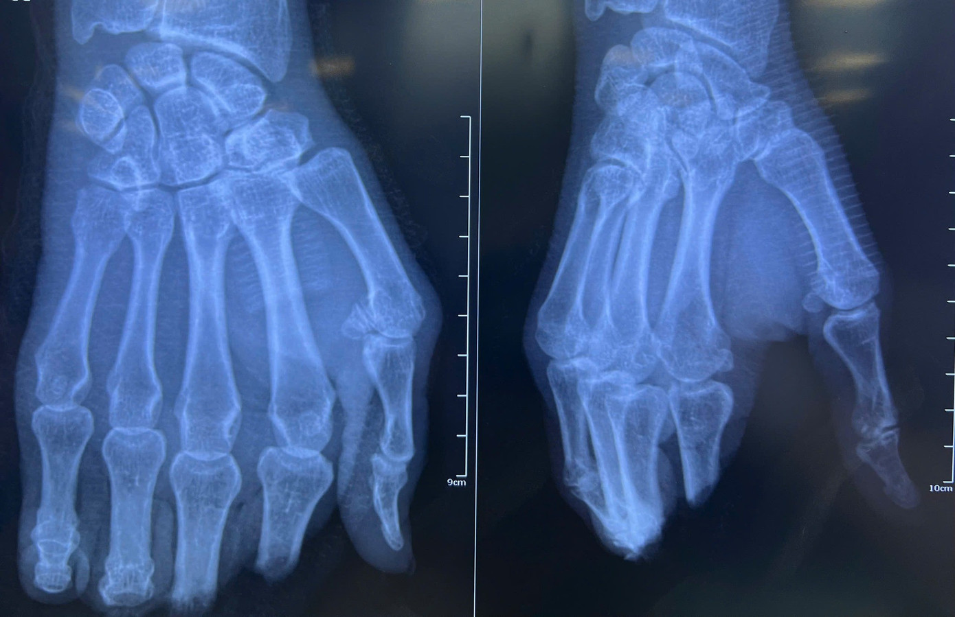 Xuy&ecirc;n đ&ecirc;m phẫu thuật cứu 4 ng&oacute;n tay bị m&aacute;y ch&eacute;m đứt l&igrave;a ở TPHCM- Ảnh 1.