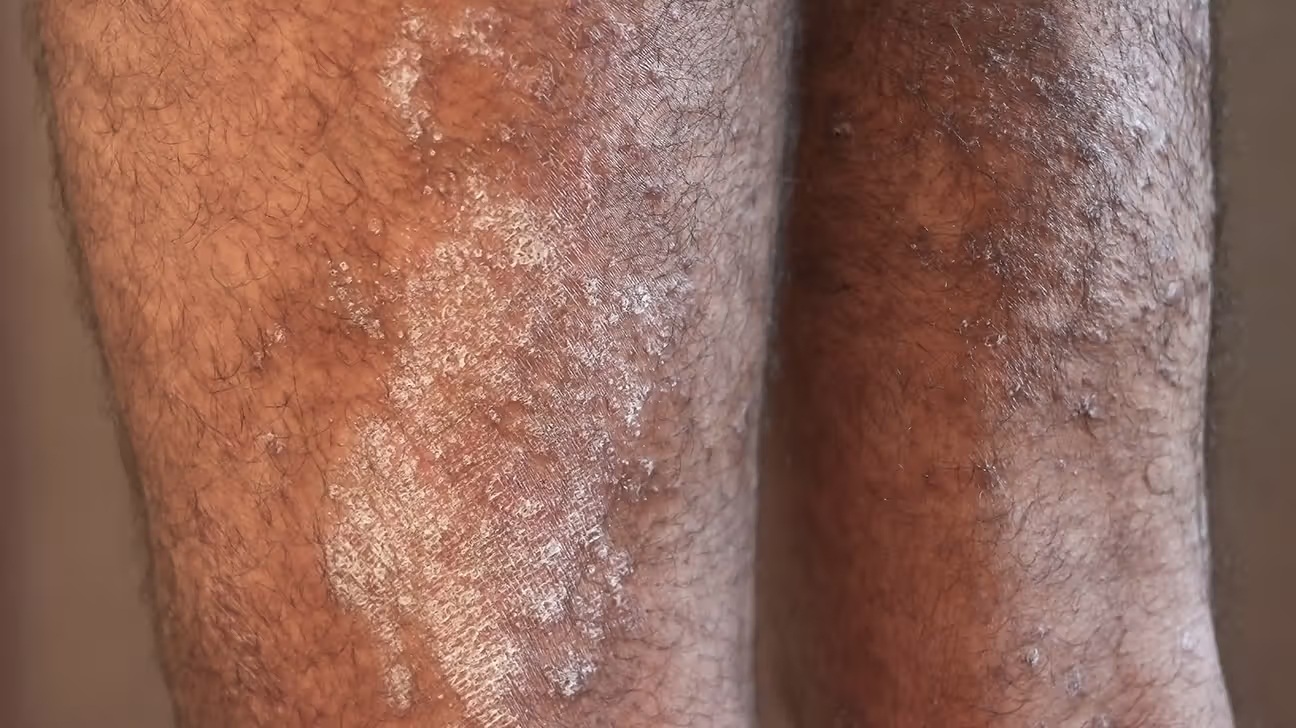 Muốn biết thận khỏe hay kh&ocirc;ng, cứ nh&igrave;n v&agrave;o da sẽ r&otilde;: Đ&acirc;y l&agrave; 7 dấu hiệu nếu c&oacute; cần đi kh&aacute;m ngay- Ảnh 2.