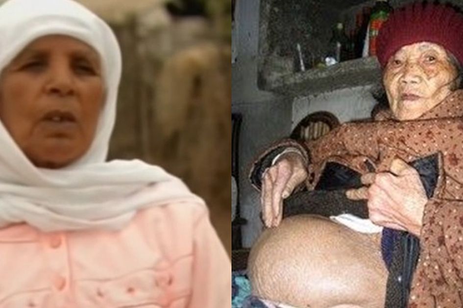 Người phụ nữ mang thai suốt 46 năm m&agrave; kh&ocirc;ng hề hay biết cho đến khi 75 tuổi- Ảnh 1.