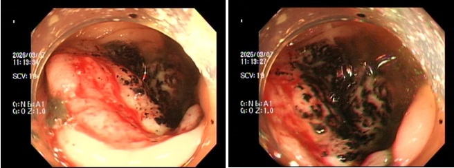 Ng&agrave;y c&agrave;ng nhiều người trẻ bị ung thư đại trực tr&agrave;ng, Bệnh viện Nh&acirc;n d&acirc;n 115 đưa ra khuyến c&aacute;o KHẨN- Ảnh 1.