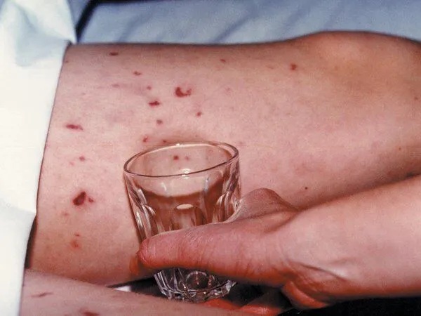 Gia tăng căn bệnh dễ l&acirc;y, &lsquo;tấn c&ocirc;ng&rsquo; v&agrave;o n&atilde;o: B&aacute;c sĩ chỉ c&aacute;ch nhận biết ở giai đoạn mới nhiễm- Ảnh 1.