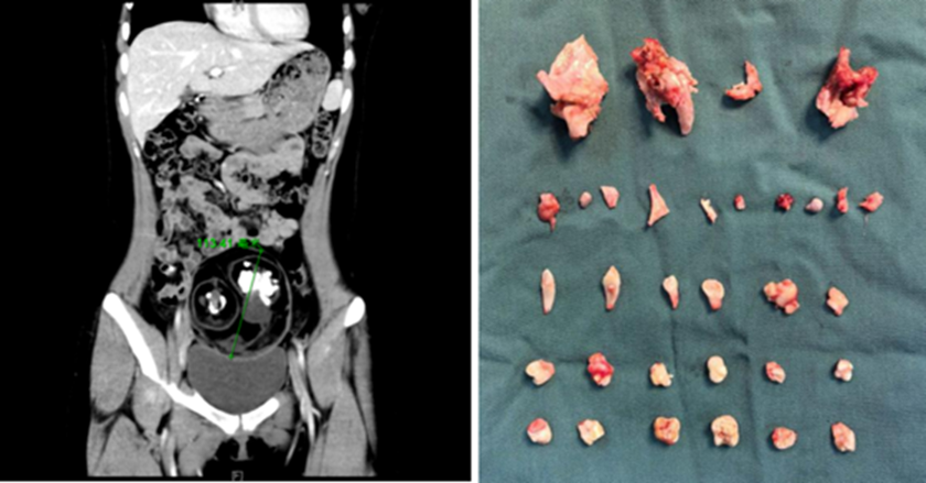 Nữ sinh 18 tuổi đau bụng dữ dội khi tập thể dục, ngỡ ng&agrave;ng ph&aacute;t hiện 24 chiếc răng nằm b&ecirc;n trong- Ảnh 1.
