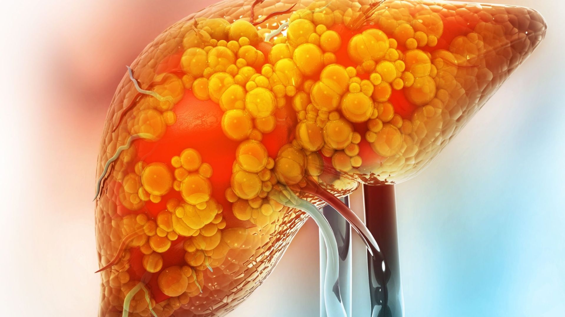 B&aacute;c sĩ n&oacute;i thẳng: Th&oacute;i quen n&agrave;y &acirc;m thầm g&acirc;y gan nhiễm mỡ nhưng to&agrave;n bị xem nhẹ- Ảnh 1.