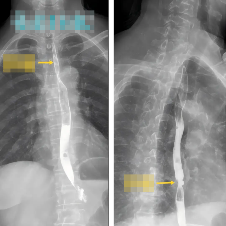 2 vợ chồng c&ugrave;ng mắc ung thư thực quản v&igrave; loại nước nhiều người th&iacute;ch: Uống mỗi ng&agrave;y l&agrave;m tăng gấp 6 lần nguy cơ ung thư- Ảnh 2.