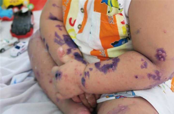 Gần 3.000 trẻ mắc ch&acirc;n tay miệng trong 2 th&aacute;ng, 3 dấu hiệu cần đưa con đi viện- Ảnh 1.