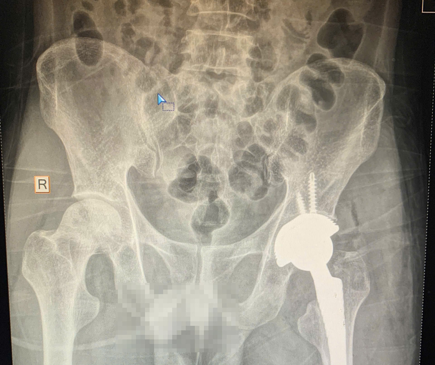 Hoại tử chỏm xương đ&ugrave;i tấn c&ocirc;ng người trẻ, cảnh b&aacute;o nguy cơ t&agrave;n phế- Ảnh 2.