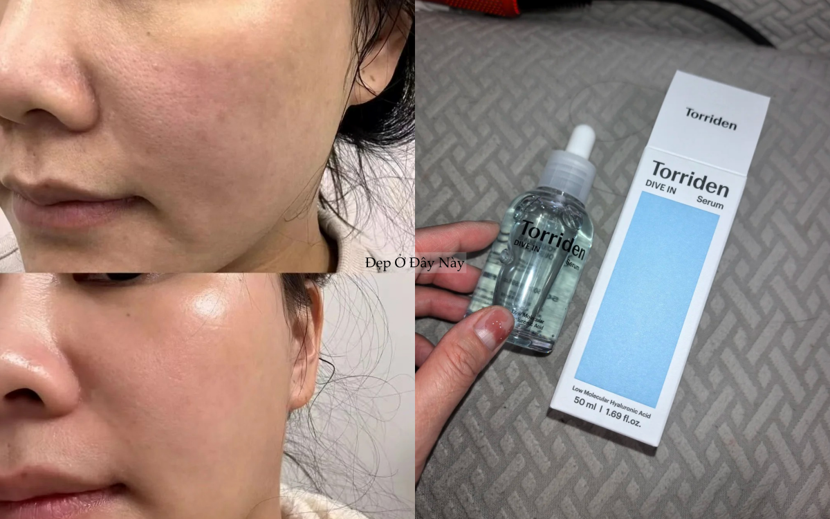 Chuy&ecirc;n gia chỉ ra: C&oacute; tới 4 loại lỗ ch&acirc;n l&ocirc;ng to v&agrave; c&aacute;ch khắc phục hiệu quả nhất- Ảnh 3.