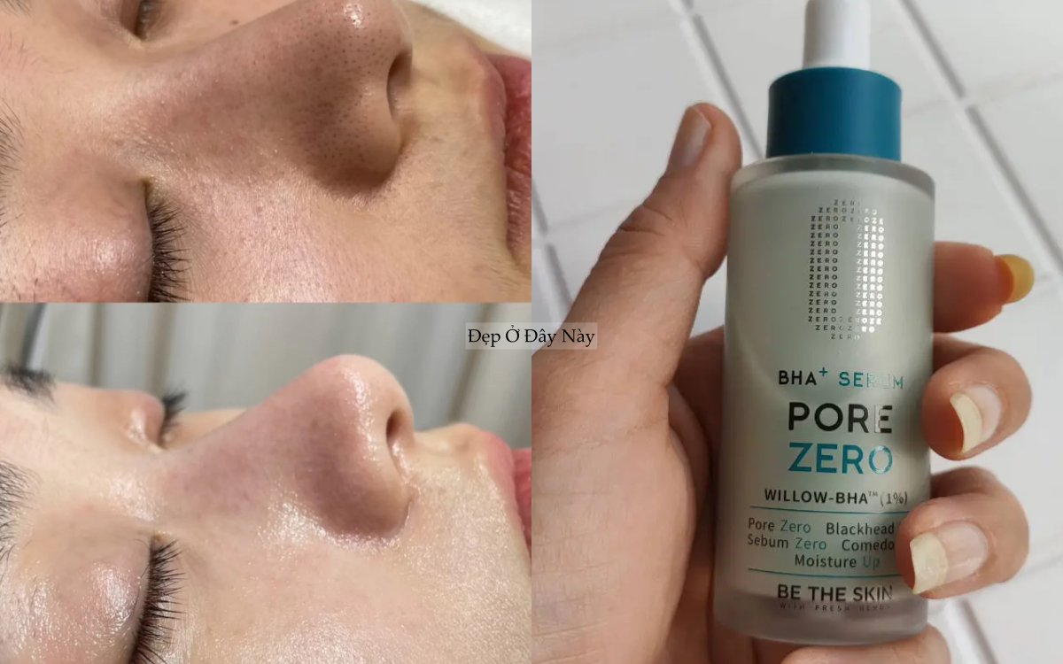 Chuy&ecirc;n gia chỉ ra: C&oacute; tới 4 loại lỗ ch&acirc;n l&ocirc;ng to v&agrave; c&aacute;ch khắc phục hiệu quả nhất- Ảnh 4.