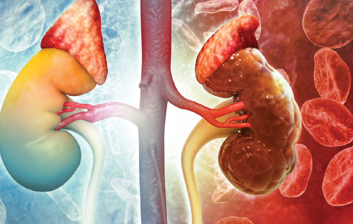 Suy thận c&oacute; thể tấn c&ocirc;ng bất ngờ kh&ocirc;ng b&aacute;o trước: Đ&acirc;y l&agrave; 4 đối tượng cần đặc biệt cảnh gi&aacute;c- Ảnh 1.