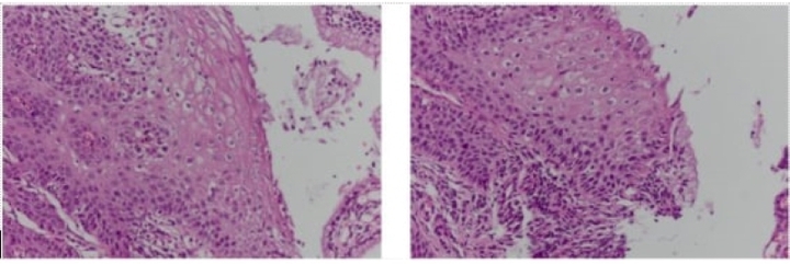 Kh&aacute;m tiền h&ocirc;n nh&acirc;n, c&ocirc; g&aacute;i ph&aacute;t hiện sớm ung thư cổ tử cung- Ảnh 1.