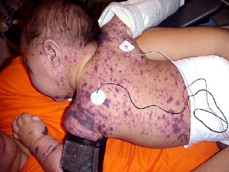 B&aacute;c sĩ cảnh b&aacute;o sau ca tử vong do n&atilde;o m&ocirc; cầu- Ảnh 1.