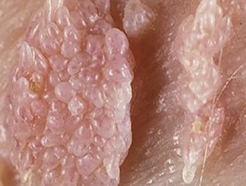 Người đàn ông gần 70 tuổi mắc sùi mào gà sau quan hệ không an toàn- Ảnh 1. Người đàn ông gần 70 tuổi mắc sùi mào gà sau quan hệ không an toàn- Ảnh 1.