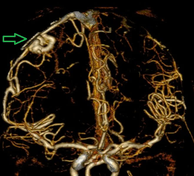 B&aacute;c sĩ cảnh b&aacute;o "quả bom nổ chậm" trong n&atilde;o: Người trẻ dễ chủ quan với dấu hiệu n&agrave;y- Ảnh 1.