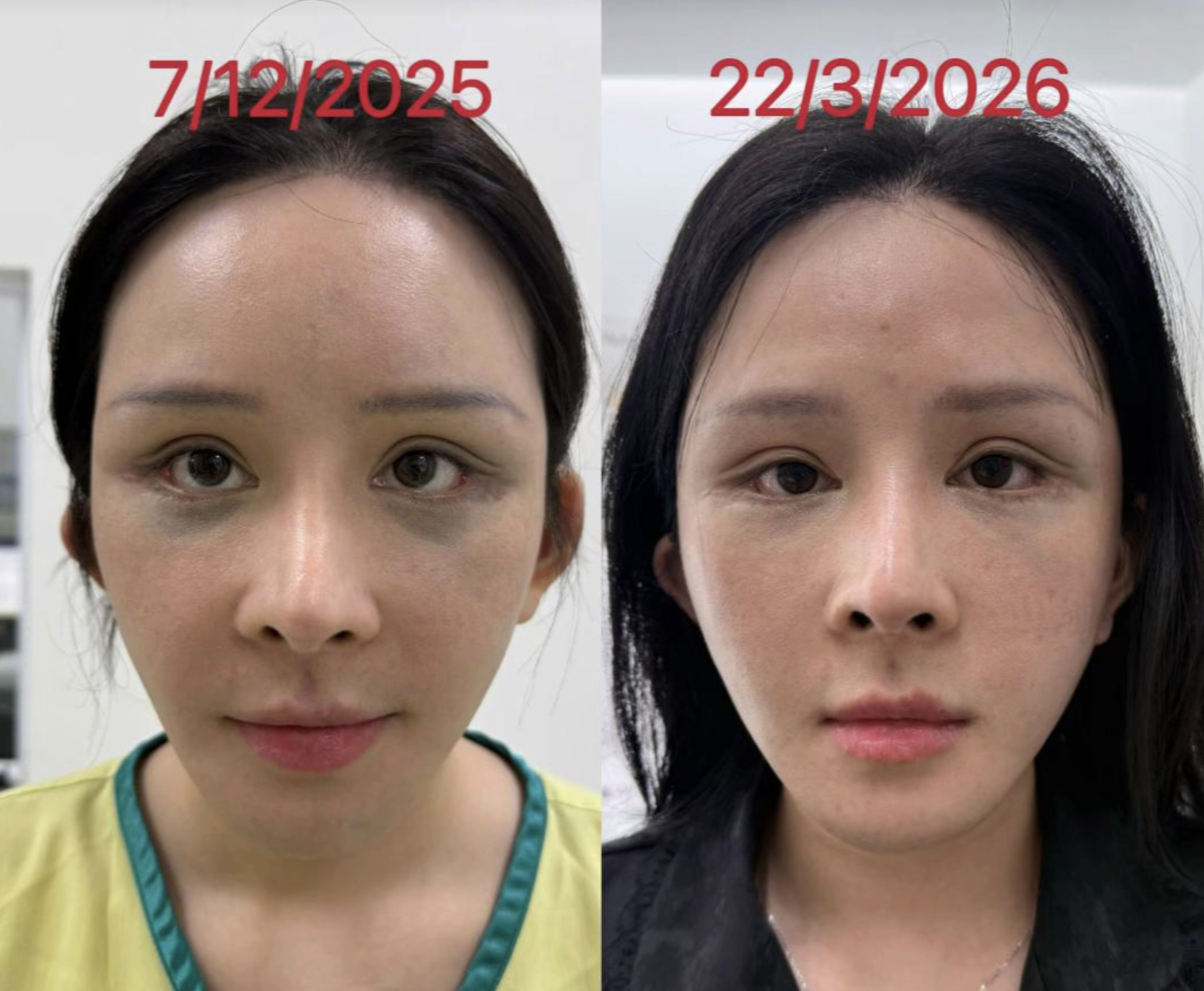 X&ocirc;n xao vụ c&ocirc; g&aacute;i h&uacute;t mỡ hết 70 triệu nhận lại mặt biến dạng, nửa đ&ecirc;m "phốt" b&aacute;c sĩ thẩm mỹ: Ph&iacute;a b&aacute;c sĩ n&oacute;i g&igrave;?- Ảnh 6.