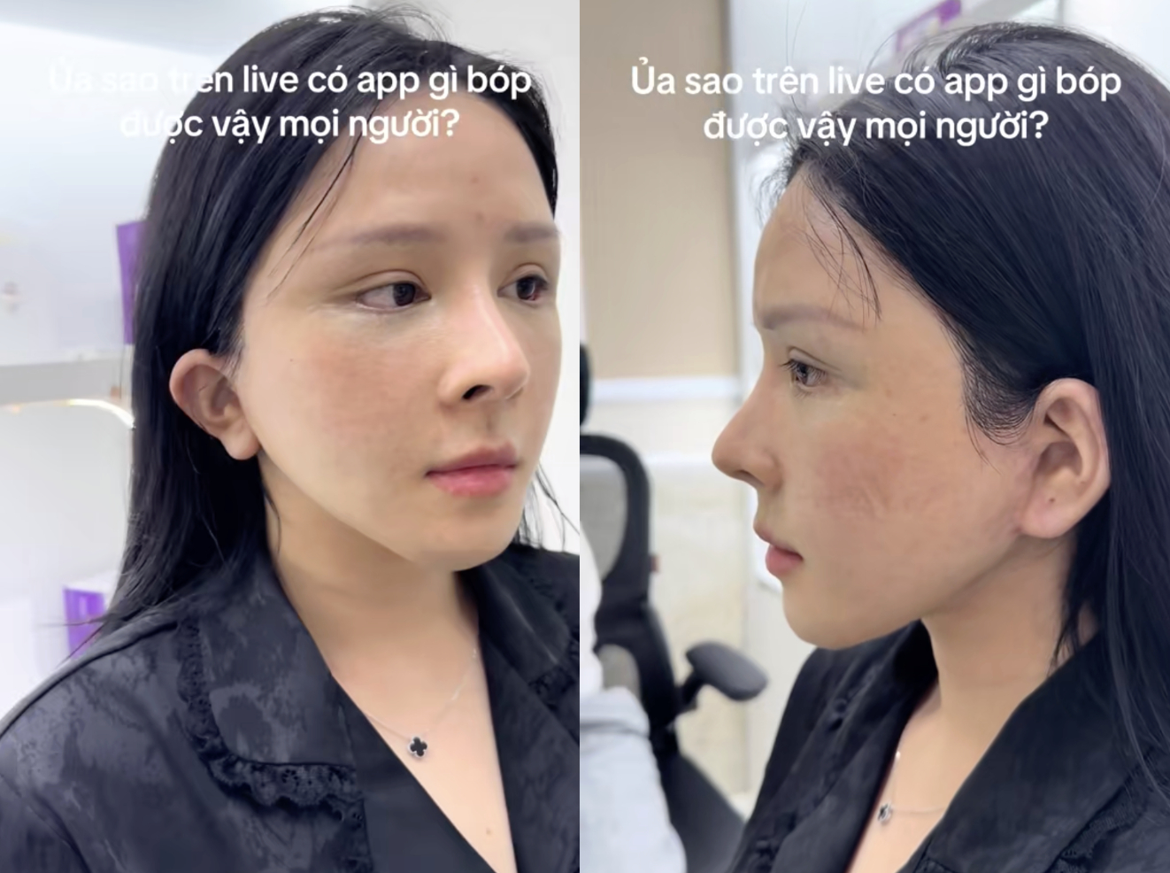 X&ocirc;n xao vụ c&ocirc; g&aacute;i h&uacute;t mỡ hết 70 triệu nhận lại mặt biến dạng, nửa đ&ecirc;m "phốt" b&aacute;c sĩ thẩm mỹ: Ph&iacute;a b&aacute;c sĩ n&oacute;i g&igrave;?- Ảnh 5.