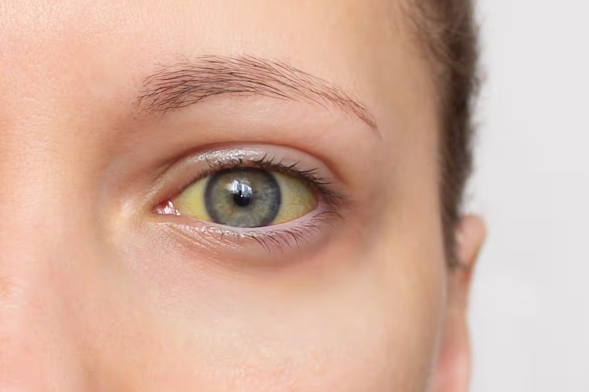 Cảnh báo 4 dấu hiệu của loại ung thư "sát thủ thầm lặng": Nếu có phải đi khám ngay- Ảnh 1. Cảnh báo 4 dấu hiệu của loại ung thư "sát thủ thầm lặng": Nếu có phải đi khám ngay- Ảnh 1.