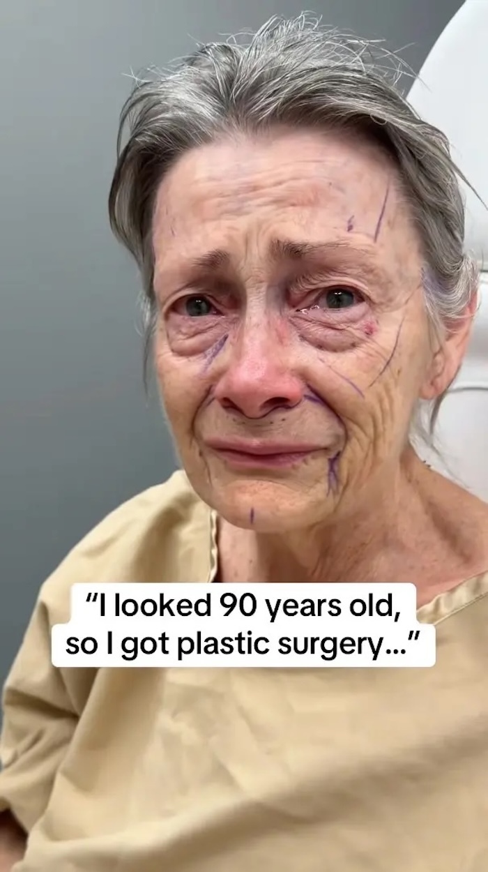 Cụ b&agrave; tr&ocirc;ng như 90 tuổi trẻ h&oacute;a kỳ diệu sau phẫu thuật căng da- Ảnh 1.