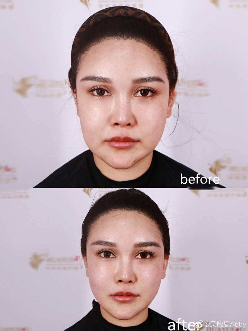 C&ocirc; g&aacute;i cao 1m80 bị &eacute;p dao k&eacute;o từ năm 14 tuổi, hơn 300 lần phẫu thuật: Gương mặt hiện tại thế n&agrave;o?- Ảnh 5.