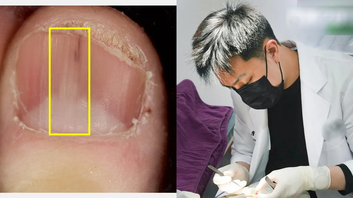 Người phụ nữ 45 tuổi ph&aacute;t hiện khối u từ 1 dấu hiệu ở m&oacute;ng tay nhiều người bỏ qua- Ảnh 1.