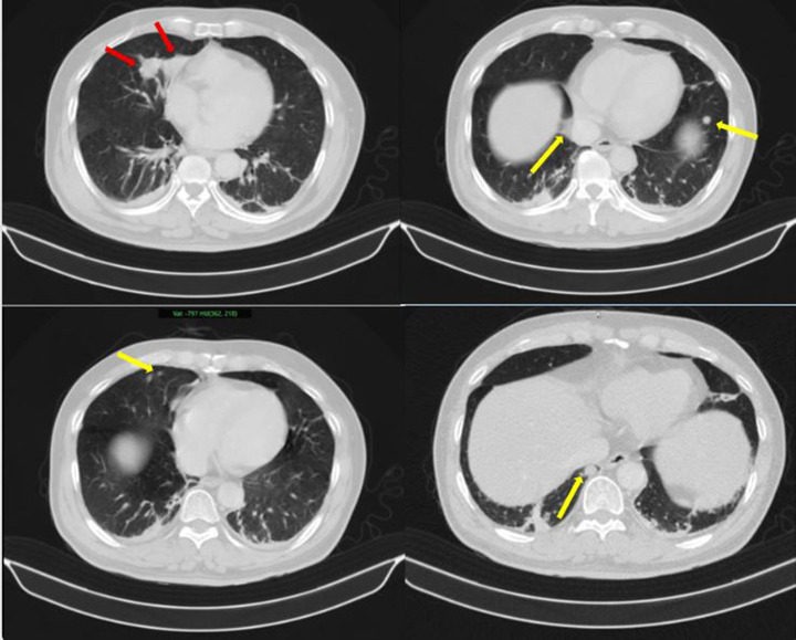Người đ&agrave;n &ocirc;ng ph&aacute;t hiện mắc hai bệnh ung thư c&ugrave;ng l&uacute;c- Ảnh 1.